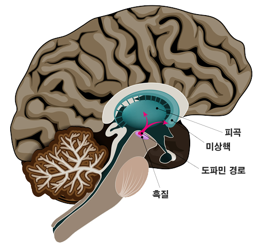 파킨슨병 설명 예시이미지