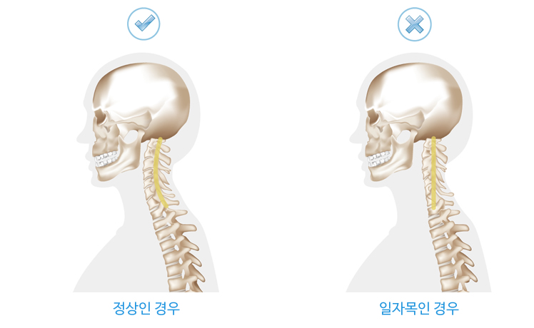 일자목, 거북목 예시이미지