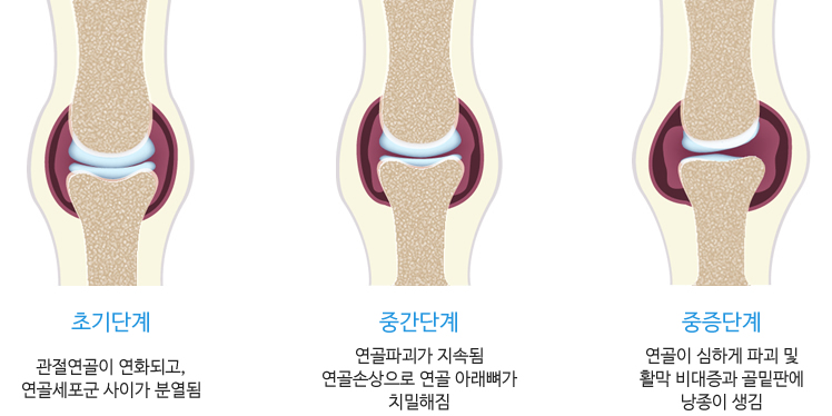퇴행성관절염의 진행단계 예시이미지