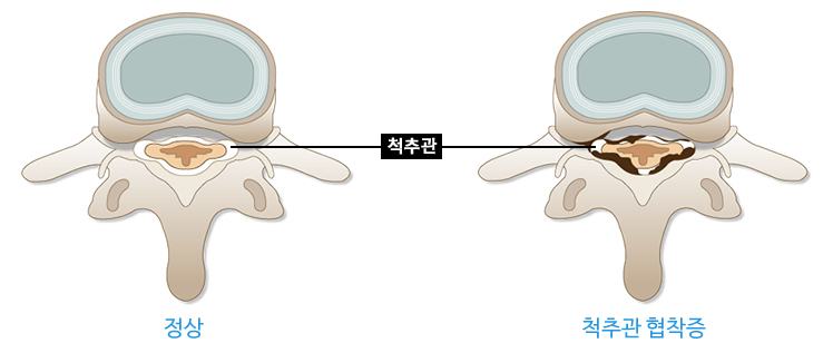 척추관협착증의 설명 예시이미지