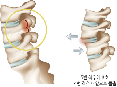 척추 분리증 및 척추 전방 전위증 설명 예시이미지